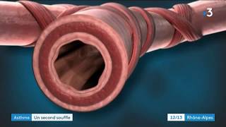 Thermoplastie bronchique  nouvelle thérapie pour les asthmatique sévères [upl. by Assennev874]