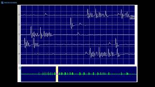 Kimura amp Kohara F34 Typical myokymic discharge seen in a demyelinating neuropathy [upl. by Launce664]