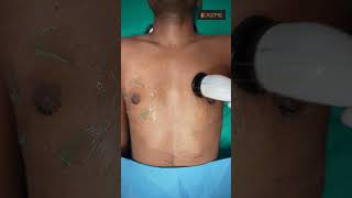 Gynecomastia cure  Dressing removal amp RF Session shorts [upl. by Alohcin714]