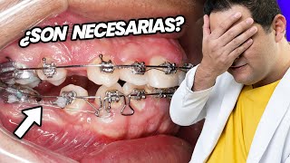 ¡La GUERRA de las EXTRACCIONES de PREMOLARES ¿SACAR DIENTES Es NECESARIO para tu TRATAMIENTO [upl. by Duval257]