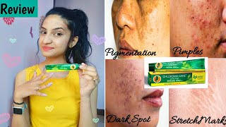 Choasma Care Cream For HyperPigmentation Pimples Blemishes Stretch Marks Review Usages Pros [upl. by Ernestine]