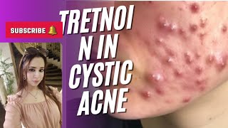 Use of isotretinoin in cystic acne [upl. by Ecnirp]