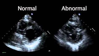 Echocardiogram from the Patient Compared with That from a Normal Control  NEJM [upl. by Ynnal257]