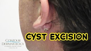 Stubborn Reoccurring Cyst Needs Removal [upl. by Nakeber]