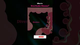 What is Diverticular Disease 💯💪🧠 health science life shorts [upl. by Bellda]