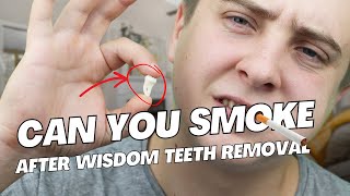 When Can You Smoke After Wisdom Teeth Removal [upl. by Anits]