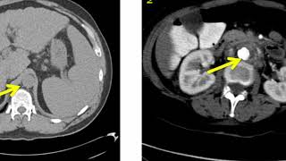 Introduction to Radiology Computed Tomography [upl. by Herwick]