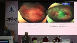 AIOC2024 GP137 Topic Dr Sharad Bhomaj Whitish yellowish veils seen on fundus examination…what am I [upl. by Todd430]