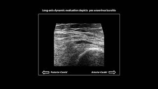 Pes anserinus bursitis on knee ultrasound [upl. by Weber468]