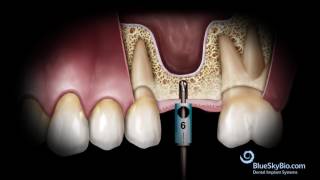 Advanced Simplified Sinus Lift Technique No Probe [upl. by Mohun]