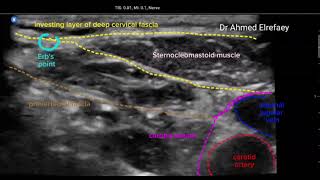 Intermediate cervical plexus block [upl. by Patrich]