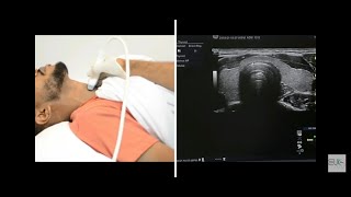 Thyroid Ultrasound Protocol [upl. by Ymer]