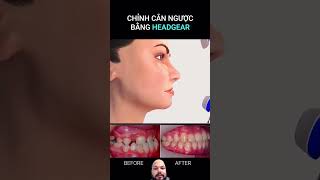 headgear orthodontics braces dentalcare satisfying [upl. by Demona]