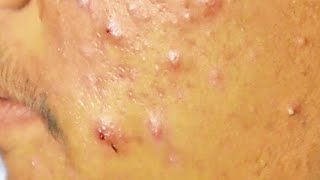 Extraction boutons et drainage le pus suintant dun acné kystique sur le visage  cystic acne [upl. by Ferrigno980]