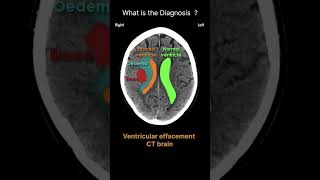 Ventricular effacement  CT brain Acute CT Brain Mass effect 77 radiologychannel007 [upl. by Imena]