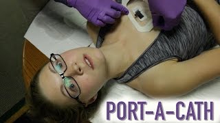 HOW TO ACCESS A PORTACATH IMPLANTED PORT [upl. by Irrac50]