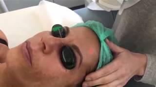 Rejuvenescimento não ablativo com Laser FriendlyLight NEO Lisboa Portugal [upl. by Atsirc374]