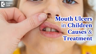 Mouth Ulcers in Children  MOUTH ULCER Treatment amp Causes  Dr K Saranya  Doctors Circle [upl. by Tabitha]