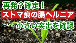 【大腸直腸がん】とうとう小さな突出を確認ショックだけど受け入れてがんばる胆力はかなり戻りつつある [upl. by Licec]