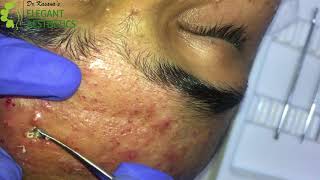 BLACKHEAD EXTRACTION by POPPING KING DRLALIT KASANA [upl. by Bully663]