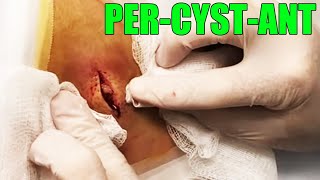 Double Bubble Cyst Dr Gilmore Cyst Removal [upl. by Zoltai]