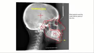 cephalometric landmarks [upl. by Akinimod390]