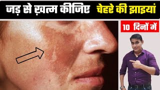 Pigmentation Rreatment At Home  Jhaiya Khatam Karne Ka Tarika  Glowing Skin Remedies [upl. by Og]