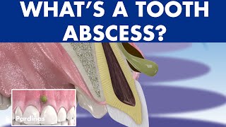 TOOTH ABSCESS dental infection  PHLEGMON symptoms and treatment © [upl. by Akiemaj]