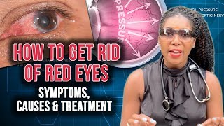 How To Get Rid Of Red Eyes Top 5 Causes 2020 [upl. by Oterol]