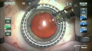 Corneal Relxing Incision Technique [upl. by Almeeta252]