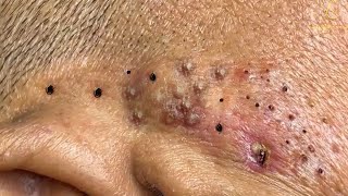 Remove Blackheads and Pimples Popping At HT Spa 38 [upl. by Haidabez299]