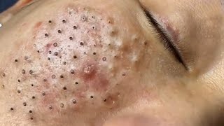 Big Cystic Acne Blackheads Extraction Blackheads amp Milia Whiteheads Removal Pimple Popping  3899 [upl. by Eugenia660]