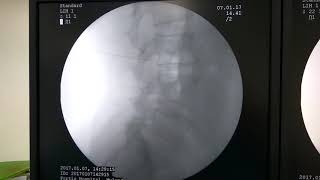 Transforaminal epidural steroid injection under fluoroscopy guidance [upl. by Larret]