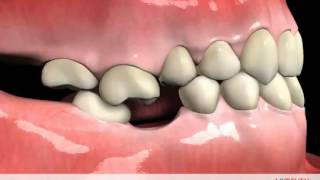 Clearwater FL Periodontist Shares Tooth movement after extraction no replacement [upl. by Drue]