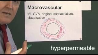 Diabetes 18 Macrovascular complications of diabetes [upl. by Steinway]