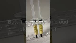 Biofiller Liquid BBL  Butt amp Hip Filler using own blood Plasma [upl. by Hsakaa221]