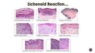 8 Lichenoid Dermatoses 2 [upl. by Oiuqise]