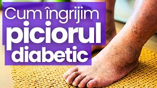 Cum prevenim și îngrijim Piciorul Diabetic [upl. by Eener]