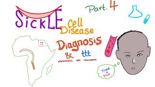 Sickle Cell Disease “part 4” Diagnosisamp treatment [upl. by Garrett689]