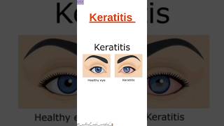 Keratitis Shorts Disease CPC Exam Medical Coding and Billing [upl. by Neeneg]