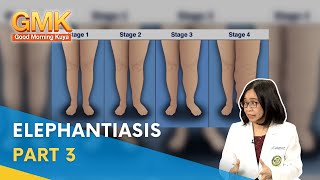 Elephantiasis Symptoms Causes and Treatment Part 3  Usapang Pangkalusugan [upl. by Iredale]