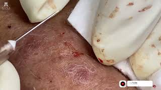 Big Cystic Acne Blackheads Extraction Blackheads amp Milia Whiteheads Removal Pimple Popping 2024 [upl. by Riocard631]