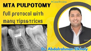 MTA adult pulpotomy how to diagnose and apply [upl. by Pence]