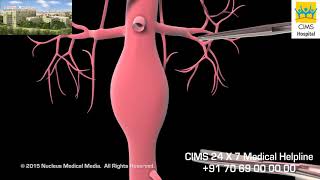 Abdominal Aortic Aneurysm AAA [upl. by Aneehsar896]