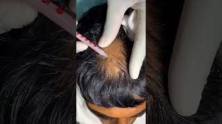 Regain your confidence Effective treatment for alopecia areata  hair regrowth  Skinaa Clinicviral [upl. by Nitsid415]