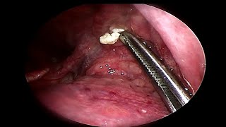 Removing LARGE Tonsil Stone  Doctor Anh [upl. by Nawuj]