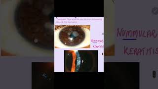 Nummular keratitis cornea keratitis eyes ophthalmology [upl. by Panthia]