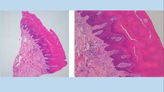 Lecture156 Congenital Naevi and other developmental abnormalities Rooks Chapter 75 [upl. by Vershen41]