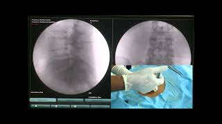 Transforaminal Epidural Under Ultrasound  Transforaminal Epidural Injection Technique [upl. by Apeed]