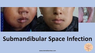 Submandibular Space Infection  Treatment by Dr Raman Dhungel [upl. by Eiba303]